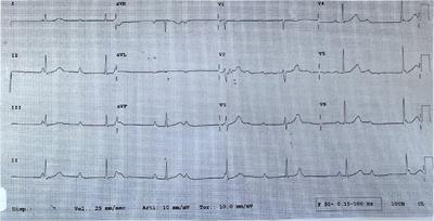 A case report of cardiac neuromodulation in a young patient with a third-degree atrioventricular block
